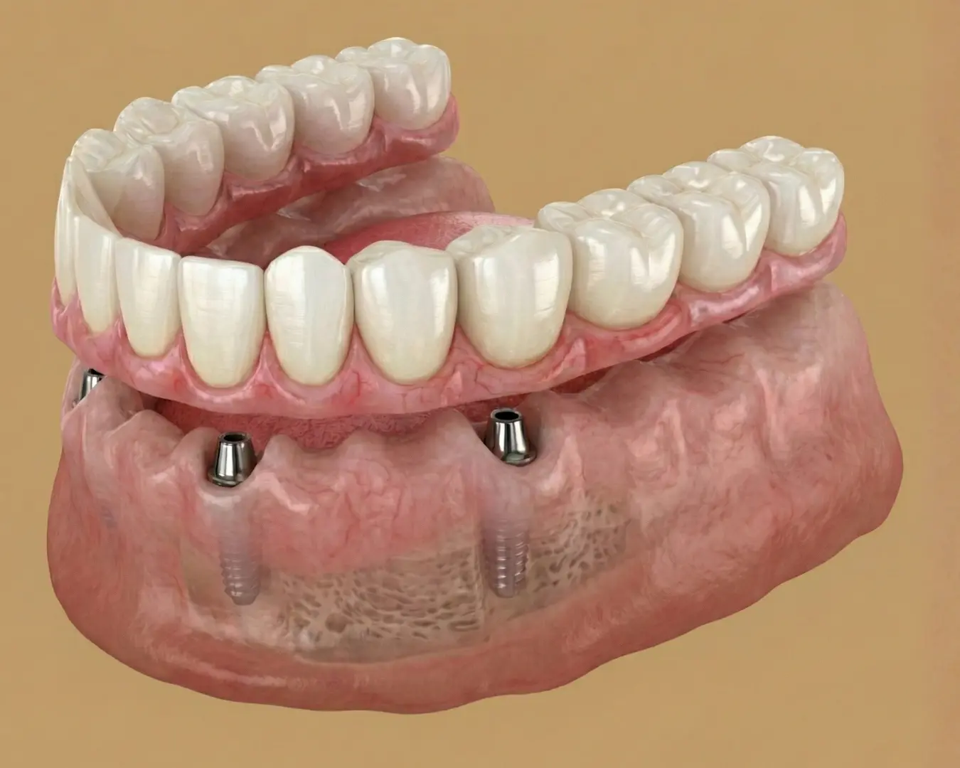 Sourire en un jour — implants Dentonella