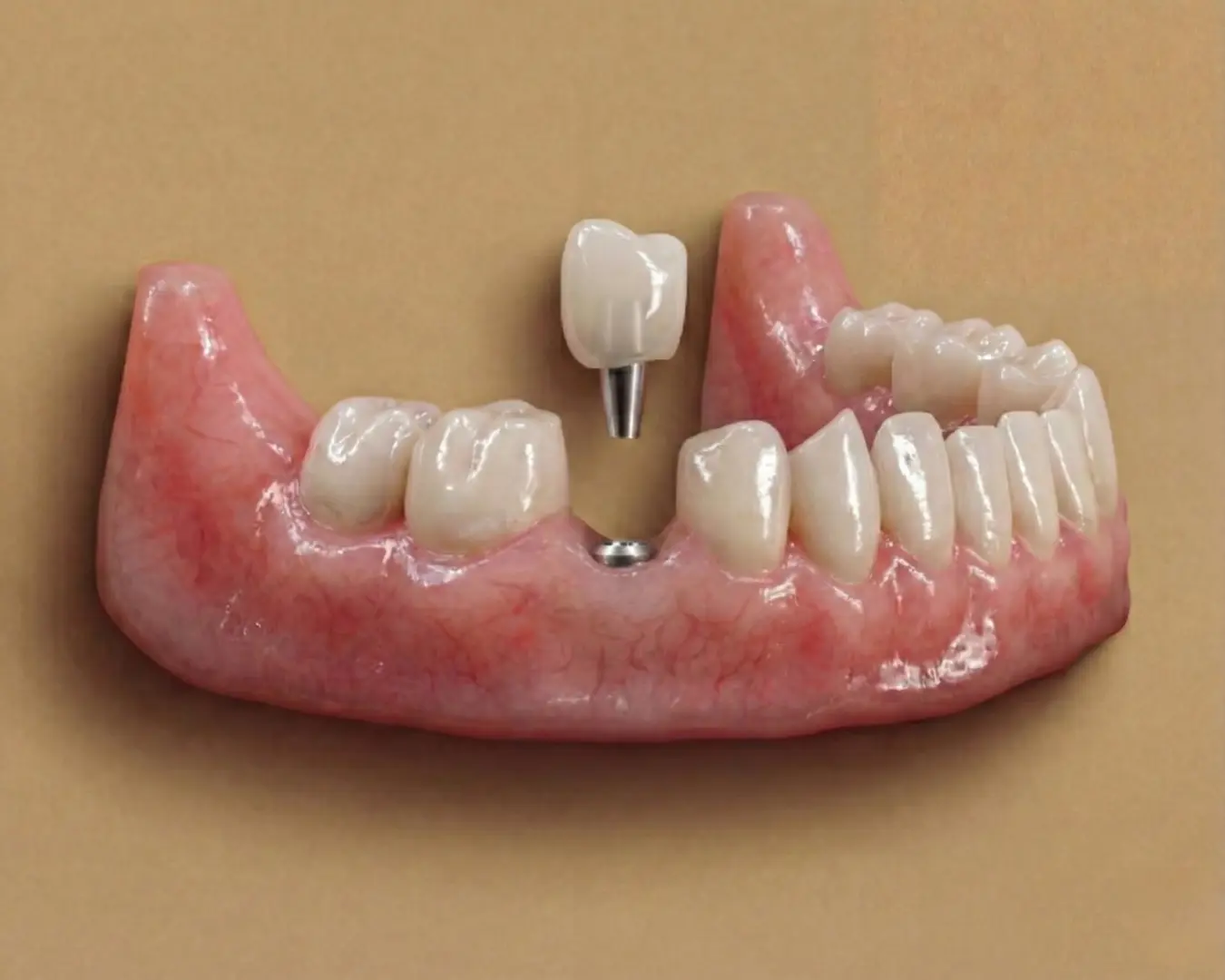 Implant dentaire unitaire