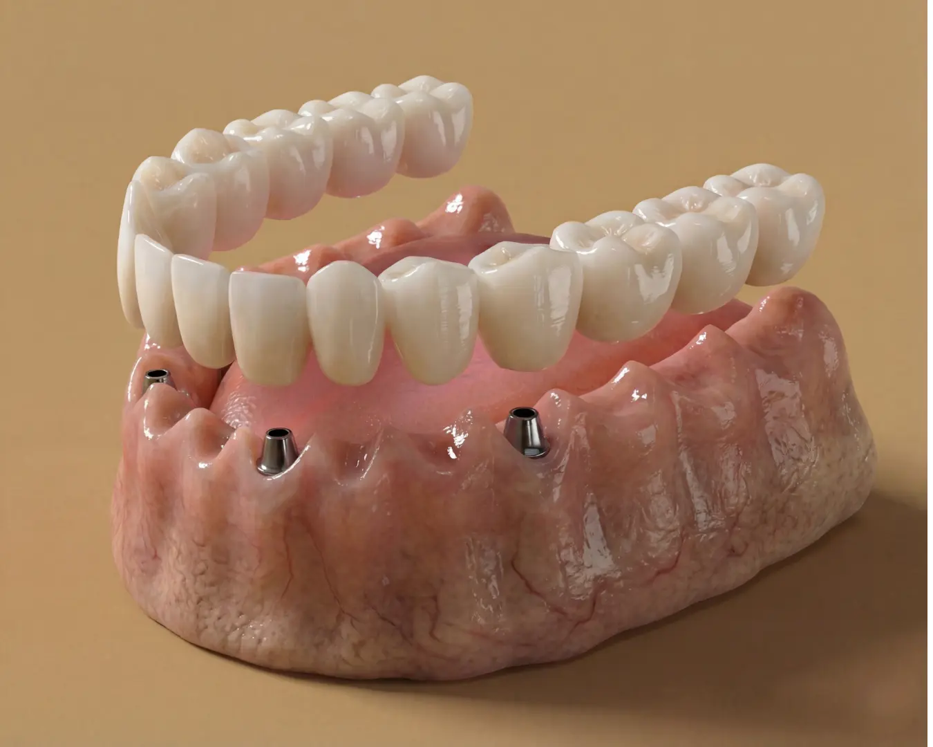 Bridge et prothèse sur implants