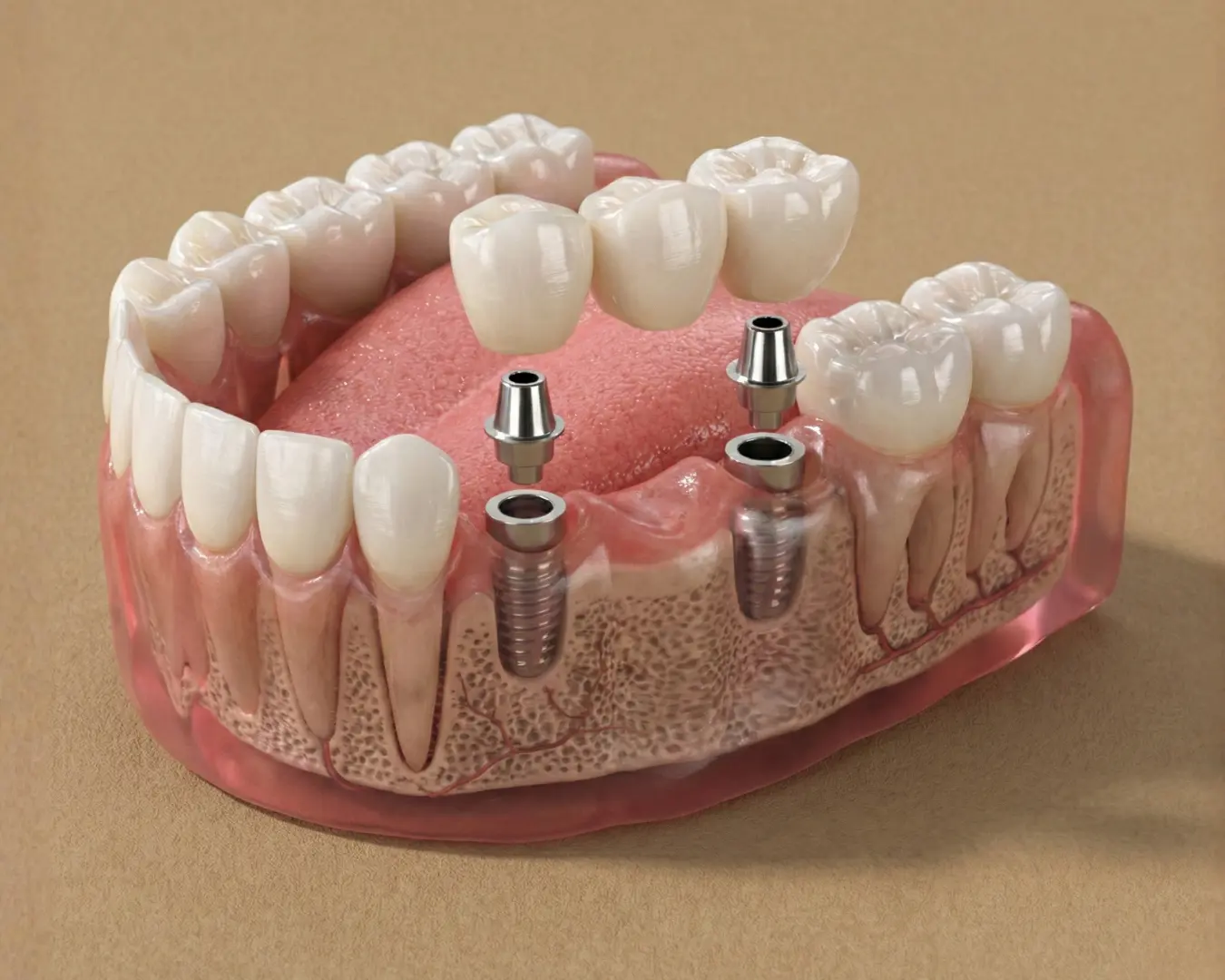 Implants dentaires multiples